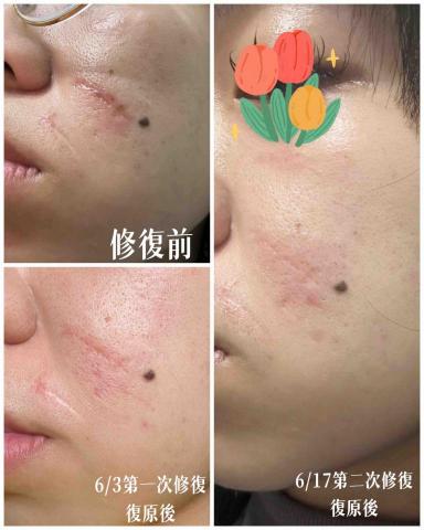 Yun-Ching Sun - 臉部車禍凹疤修復兩次