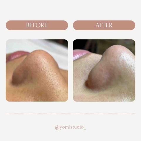 尤麋美容工作室 - 清粉刺