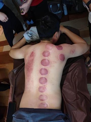 精鬆夜間按摩 - 拔罐 刮痧