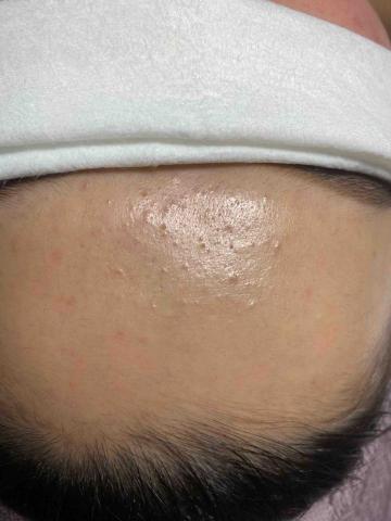 beauty美韓式肌膚管理中心 - 清除前✨
內胞粉刺
