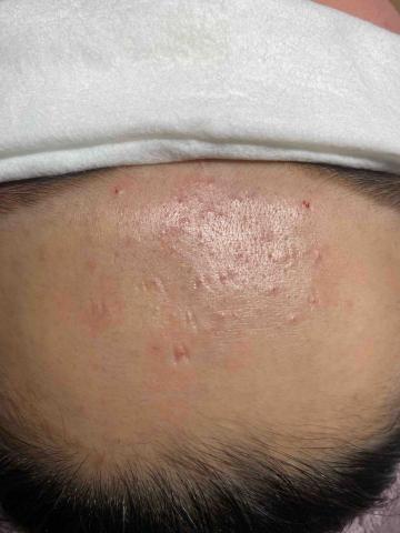 beauty美韓式肌膚管理中心 - 清除後
惱人的內胞粉刺也清的乾乾淨淨✨