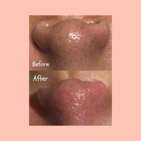 beauty美韓式肌膚管理中心 - 鼻頭粉刺清潔溜溜✨✨