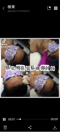 劉雨榛 - 采兒加頭部刮痧