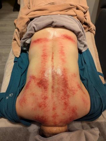 身體維修室 - 刮痧