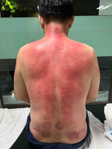 盧師傅養生殿 - 滑罐舒壓