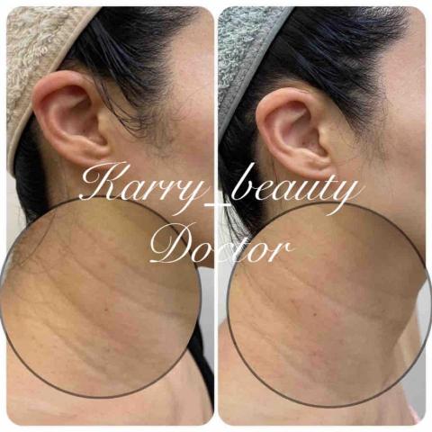 Ｋ_healthy質感調理 - 客人本身皮膚易泛紅
做完退紅直接改善很多
毛孔也縮小惹
肌膚也提亮許多
臉頰也更加緊緻拉提
撫平細紋 雀斑變淡
效果這麼好 歡迎來體驗～～