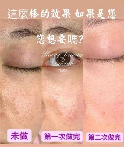 Ｋ_healthy質感調理 - 學員才聽話保養照做一週的時間
細紋跟毛孔竟然好一半～
她說遇到好的醫學美容師很重要