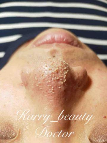 Ｋ_healthy質感調理 - 當下立即拍出的效果
大家の最愛～
大家最具話題性の美麗保養
無侵入性、無恢復期、無傷口
重點！重點！
無痛清粉刺～還能睡著！
無修圖！無濾鏡！
效果這麼好又無痛 歡迎來體驗～