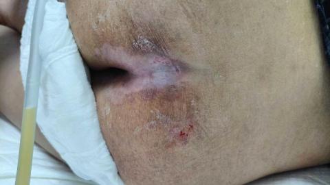 蔡佳恩 - 褥瘡換藥