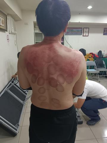 吳宗璟 - 刮痧拔罐