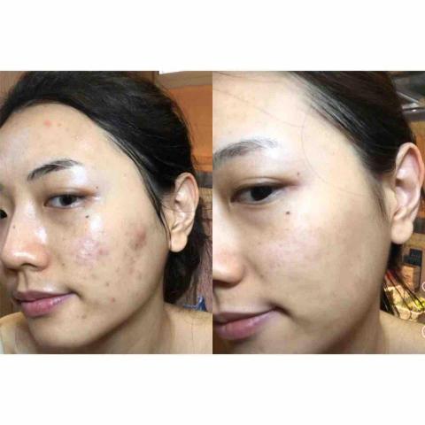 彭紫琪老師 - 肌膚管理前後效果 彭紫琪老師 - 肌膚管理前後效果