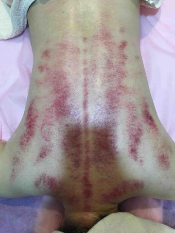 好欣晴spa - 背部刮痧（中暑）