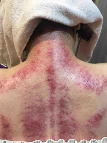 好欣晴spa - 刮痧排毒