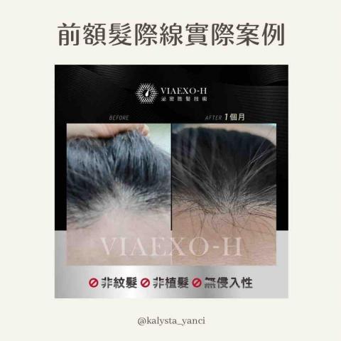 Yanci - 前額髮際線實際案例