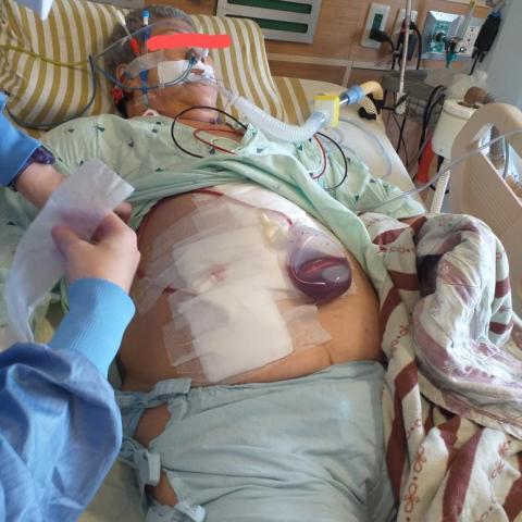 專業照服員雲乙 - 肺栓塞傳統手術