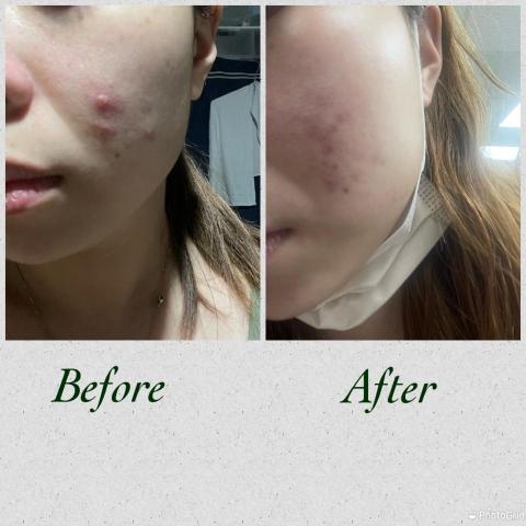 Yu - 本人的肌膚
可以看出原本非常糟
但用對保養品跟方法
也可以把皮膚變好