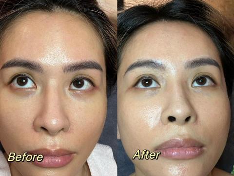 Monica膚色重建師 - 黑眼圈膚色重建（1次操作效果）