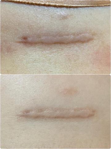 Monica膚色重建師 - 胸部下方 手術疤痕 膚色重建修飾