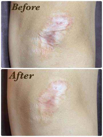 Monica膚色重建師 - 國中女生 膝蓋疤痕膚色重建（1次操作效果）