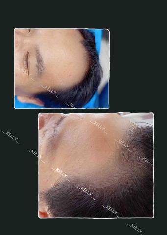 米莉美學-美甲.美睫.半永久眉眼唇.紋髮 - 髮際線非常明顯的客人,操作2次的效果,可在做加深,讓髮劑線更漂亮 米莉美學-美甲.美睫.半永久眉眼唇.紋髮 - 髮際線非常明顯的客人,操作2次的效果,可在做加深,讓髮劑線更漂亮