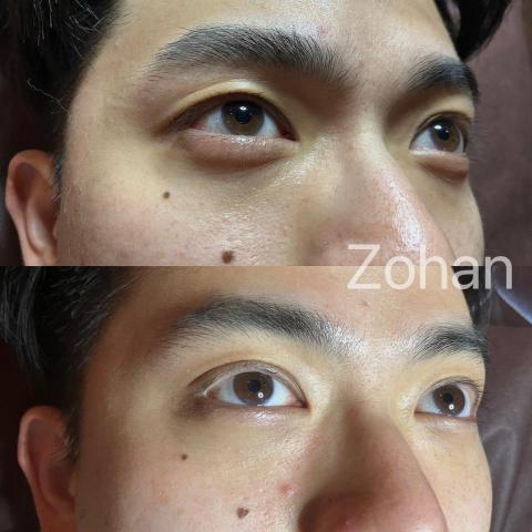 Monica膚色重建師 - 男生黑眼圈膚色重建