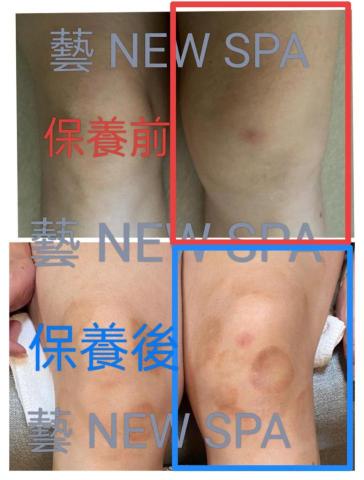 林奕妍 - 客人的膝蓋，醫生建議打洞抽水，經過修理，免打洞抽水啦?