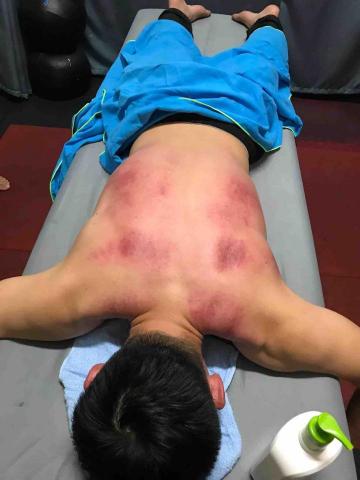 SL傳統整復推拿 - 刮痧