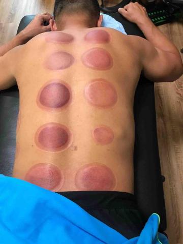 SL傳統整復推拿 - 拔罐