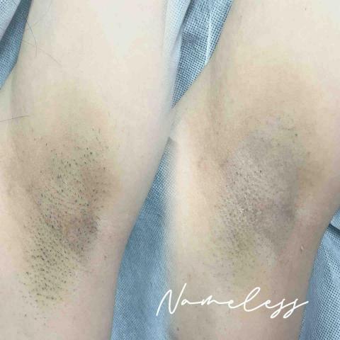 Nameless - 除毛前後
