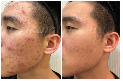 李彥瑜 - 這是我本人，左邊是開始保養前的膚況，右邊是透過專業諮詢後開始針對皮膚問題保養後改善的狀況