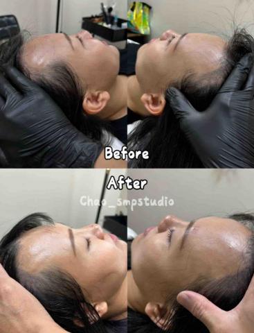 Chao Studio - 髮際線施作