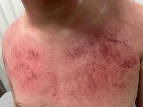 舒心工作室 - 刮痧