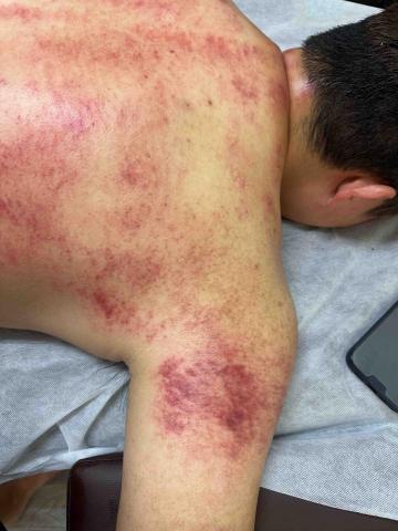 舒心工作室 - 刮痧