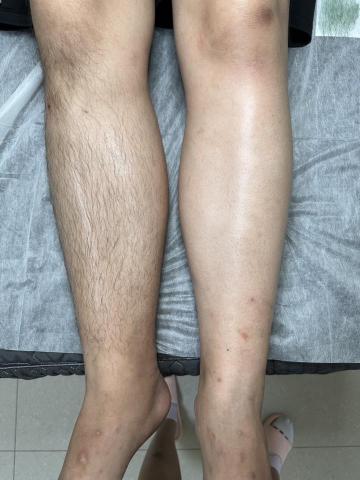 LC熱蠟美學 - 小腿全除對比圖