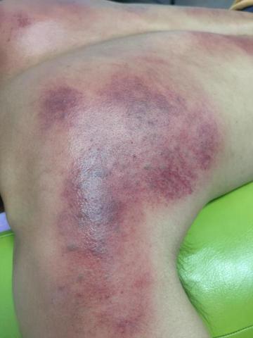 李昀傳統整復推拿 - 舊疾舉不起來