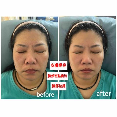 Minnie.工作室 - 臉部撥筋