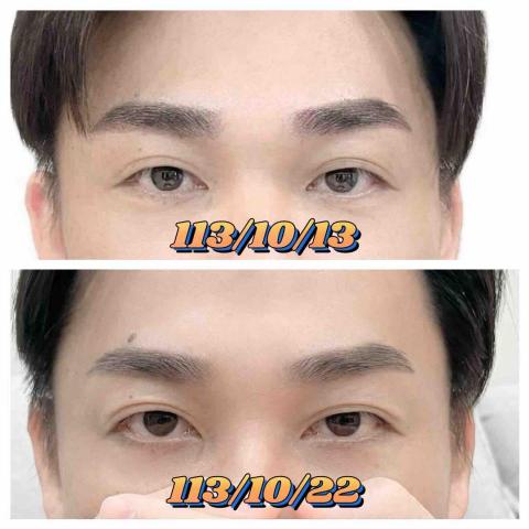 阿喧霧眉 - 霧眉完當下照與掉結痂後