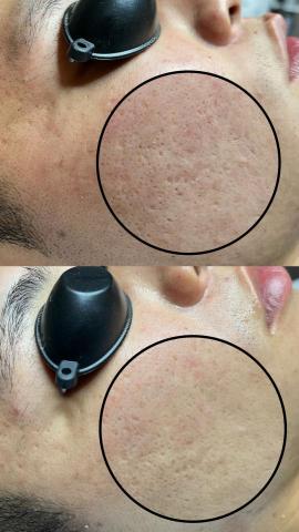 懶女孩 lazy girl_studio - 改善毛孔