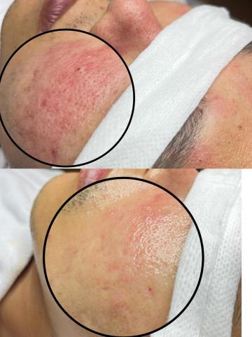 懶女孩 lazy girl_studio - 酒糟肌膚改善