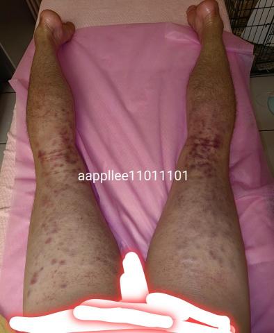 古哥搜尋小八抓龍筋 - 腿部拍痧