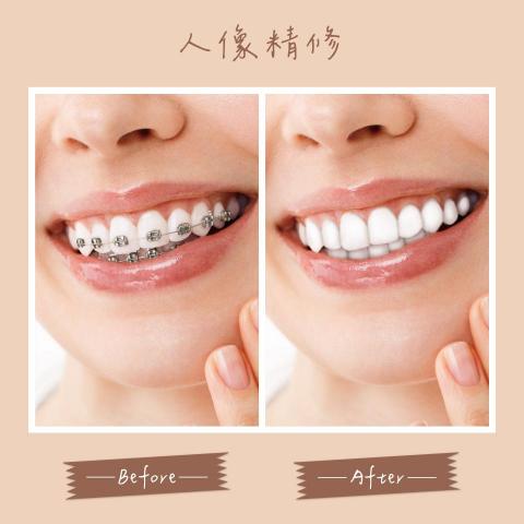 平凡設計工作室 - 去除牙套 | 人像精修
