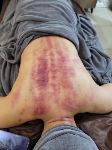 禪覺經絡按摩 - 艾灸溫罐