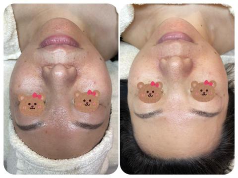 Ya靠臉吃飯 - 初次課程體驗即可改善泛紅、油光、暗沉等問題❤️