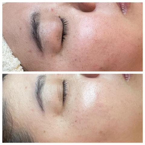 Ya靠臉吃飯 - 一次課程改善皮膚泛紅，提亮膚色❤️