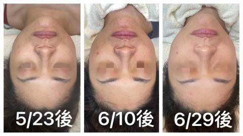 Ya靠臉吃飯 - 三次定期課程，有感改善膚色不均、暗沉蠟黃問題❤️