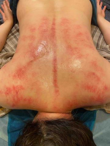 翊㚬推拿工作坊 - 艾炷溫罐～邊刮痧變補氣排濕，起到平補平洩的作用，溫經通絡，排濕排寒，溫補元氣。
更比傳統刮痧多了溫補元氣效果，做完身體馬上舒服放鬆。古言刮痧拔罐晦氣去一半，中醫講究調理身體先疏通排毒，背部的膀胱經跟各位臟腑穴位交匯，疏通膀胱經就是清理身體的排毒通道，臟腑都在背上，背部疏通很重要。溫罐疏通，邊引痧，邊祛濕，祛邪，效果極佳。天之陽為太陽，地之陽為艾草，再加點火操作，雙重陽氣溫補，做過客人回頭率非常高。
