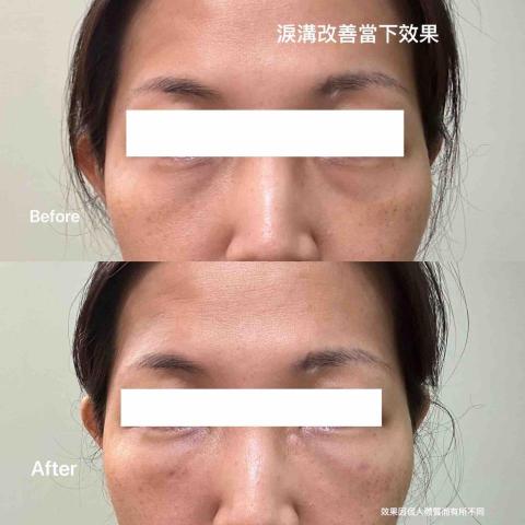 陳吟佩-心悅光身心靈美學 - 微雕-眼袋改善效果