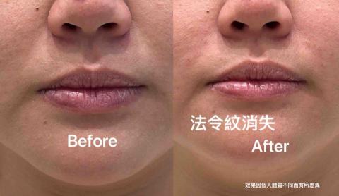 陳吟佩-心悅光身心靈美學 - 微雕-法令紋改善效果