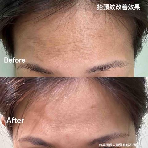 陳吟佩-心悅光身心靈美學 - 美容微雕-抬頭紋改善效果