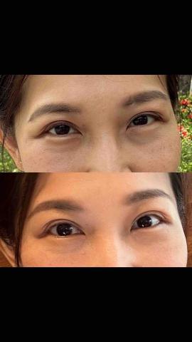 陳吟佩-心悅光身心靈美學 - 淚溝眼袋改善效果